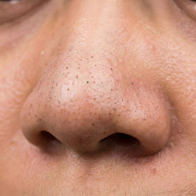 Blackheads & Whiteheads