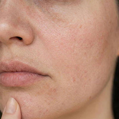 Oily & Congested Skin