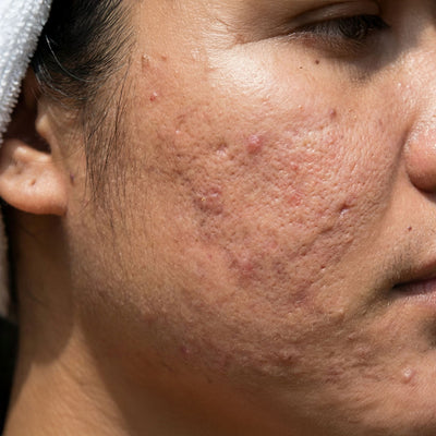 Uneven Skin Texture